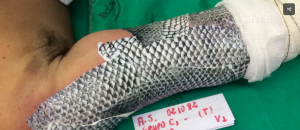 Tilapia Skin Being Used to Bandage Burns